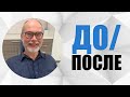 #19 случай до/после.  #Глубокий прикус, керамические брекеты. Врач: Гранцев Михаил Михайлович