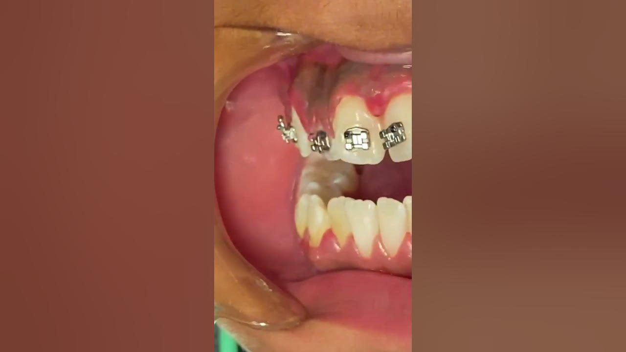 What is tongue thrust? Tongue Crib + RPE Tooth Time Family