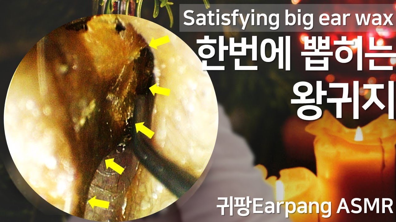 [귀팡ASMR] 어마어마한 왕귀지 Satisfying big ear wax removal YouTube
