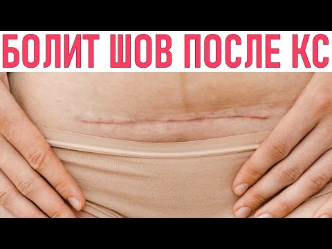 БОЛИТ ШОВ ПОСЛЕ КЕСАРЕВА СЕЧЕНИЯ | Почему болит шов после кесарева