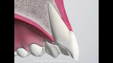 Fill The Gap Ridge Preservation with Geistlich Bio Oss® Collagen and Geistlich Bio Gide Shape®