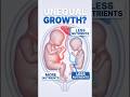 Twin growth discordance ( Twins world inside the womb)😮#shots