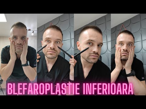 BLEFAROPLASTIE INFERIOARA - Scapa eficient de pungile de sub ochi