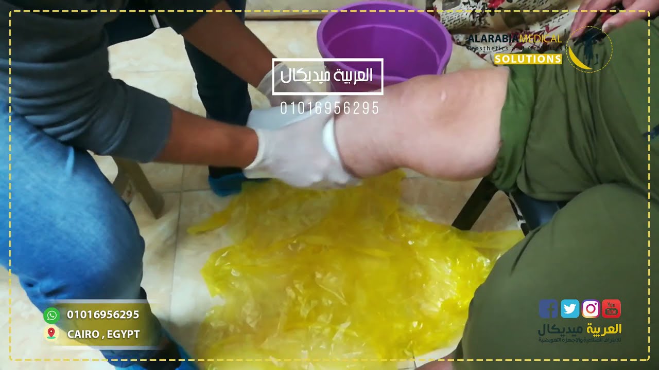 مراحل التدريب بالطرف الصناعي | طرف صناعي الماني تحت الركبة