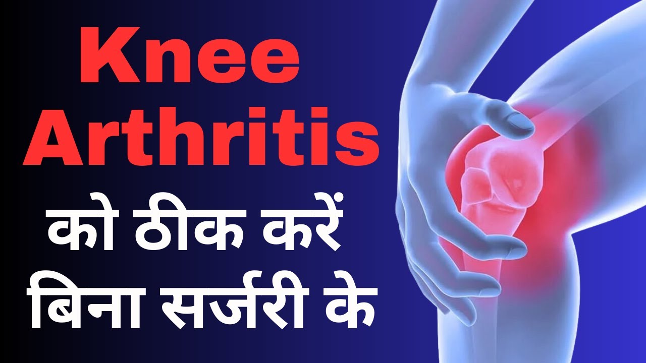 Knee Arthritis को ठीक करें बिना सर्जरी के / Cure Knee Arthritis Without