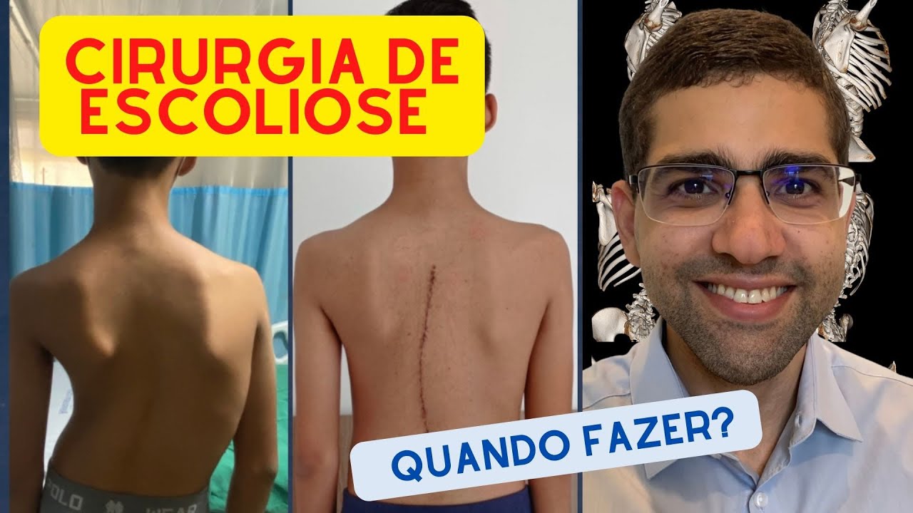 ESCOLIOSE - QUANDO OPERAR?