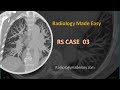 RS Case 03 : Patient with dyspnea