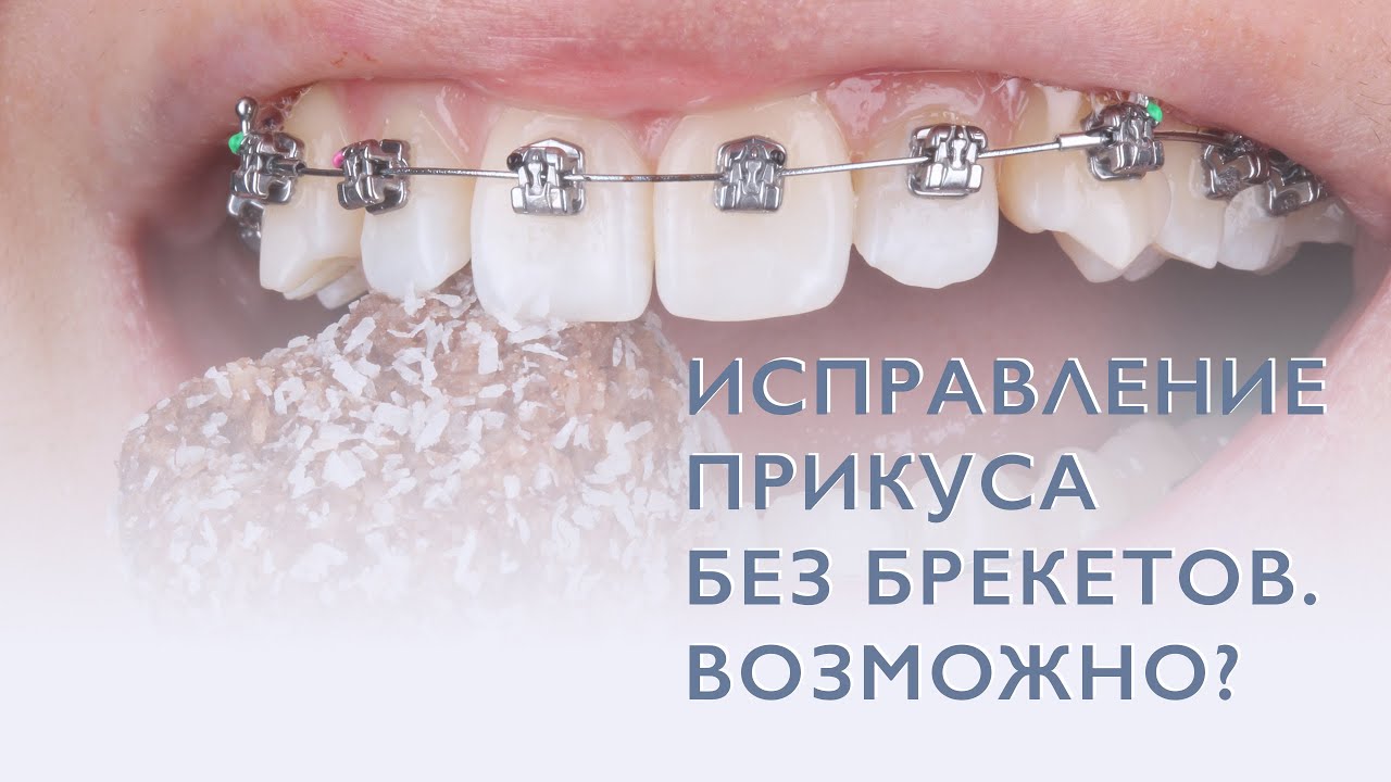 Правда ли, что прикус можно исправить не только с помощью брекетов ...