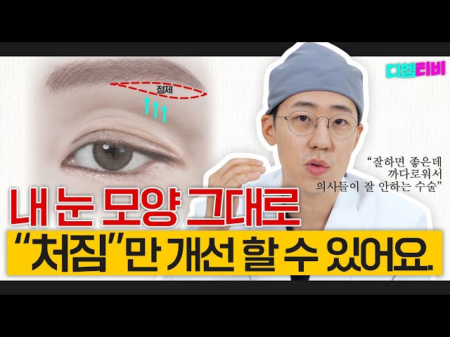 눈썹하거상이라고 아세요?    #눈썹하거상술 #중년눈성형 #눈성형