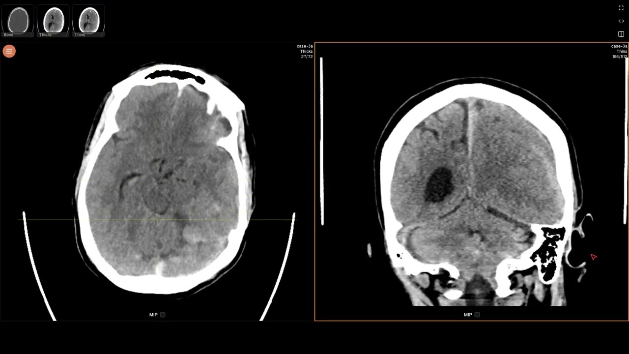 Subdural hematoma (EDNeurorad Case 3a)
