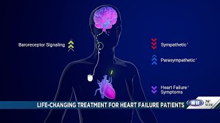 Lincoln doctor says new device could significantly improve heart failure symptoms