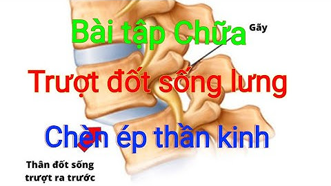 Bài Tập Chữa Trượt Đốt Sống Gây Chèn Ép Thần Kinh Đau Tê Xuống Chân.