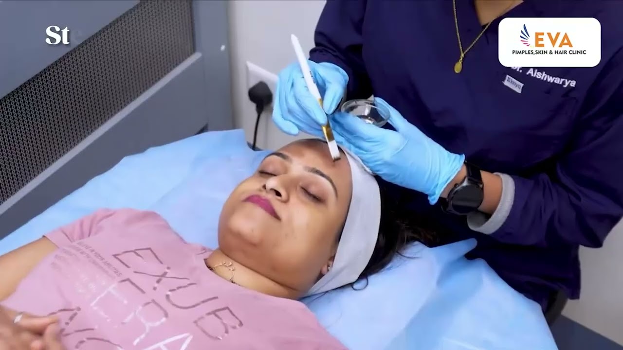 Carbon Laser Peel Complete Procedure #carbonfacial #carbonpeel #carbonpeel #medifacial #skincare