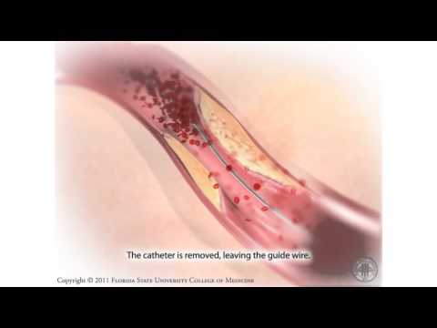 Video: Razlika Med Boleznijo Koronarnih Arterij In Aterosklerozo