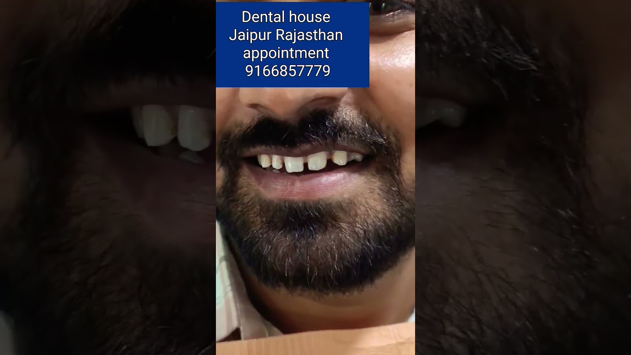 Smile design treatment// before and after smile transition// Smile