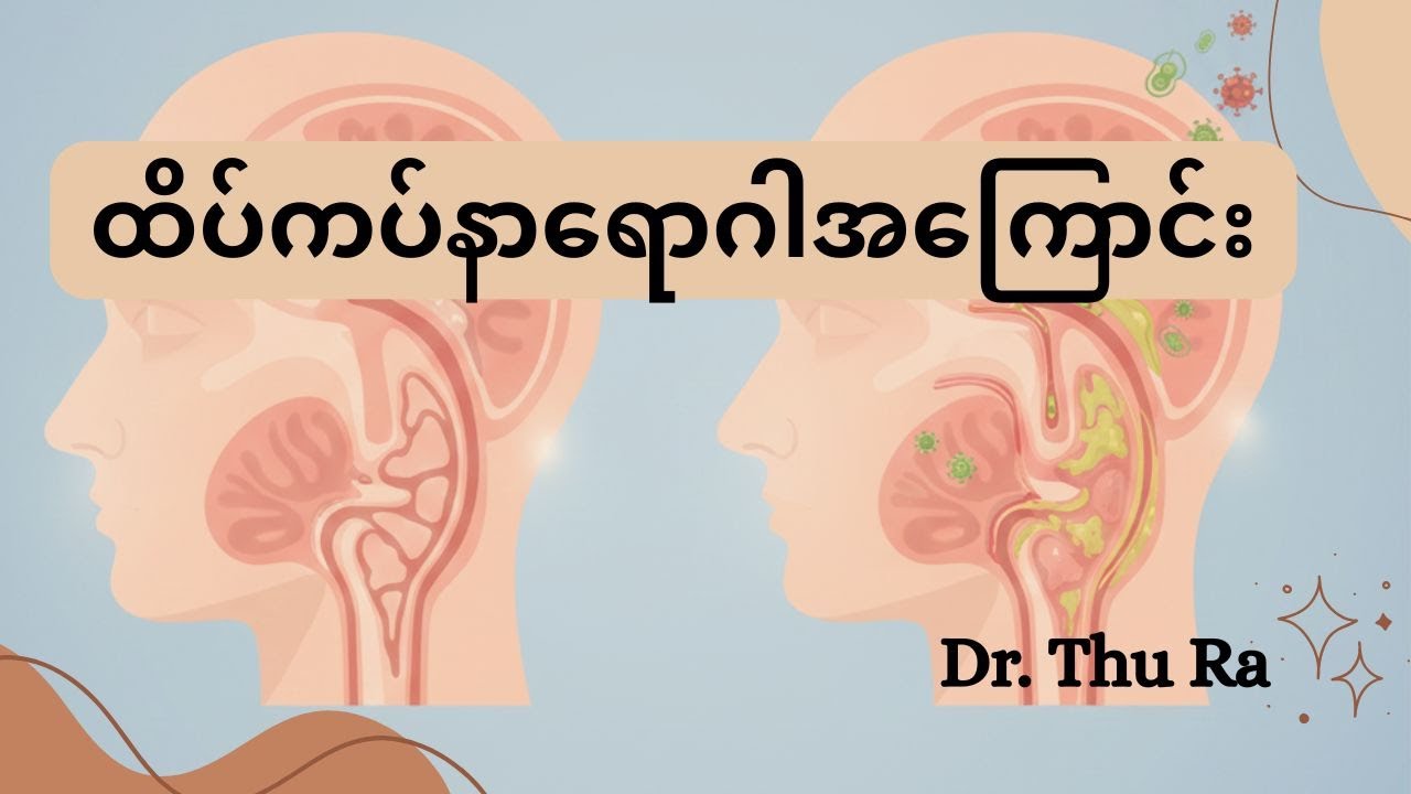 ထိပ်ကပ်နာရောဂါအကြောင်း #ကျန်းမာရေး #ထိပ်ကပ်နာ