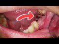 Ini Harus Dicabut dan Diganti Dengan Gigi Palsu | Tooth Extraction | Dentist | Dokter Gigi Tri Putra