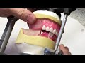 Mandibular anterior setup