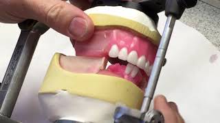 Mandibular anterior setup