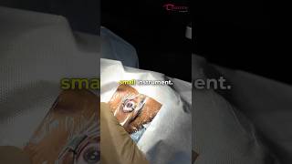 What happens if you blink during LASIK surgery? - Dr. Advaith | Envision Lasik Centre #lasiksurgery