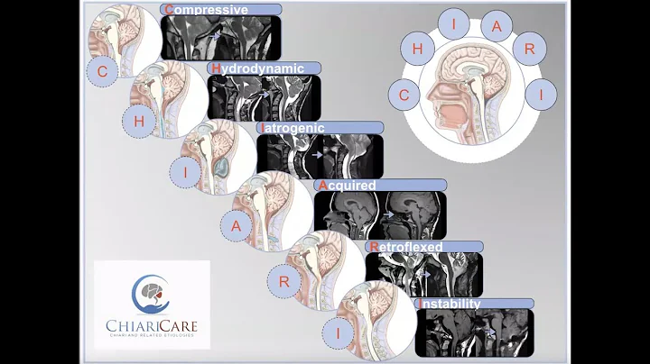 Chiari Project Presents a Q&A With Jeffrey Greenfi...