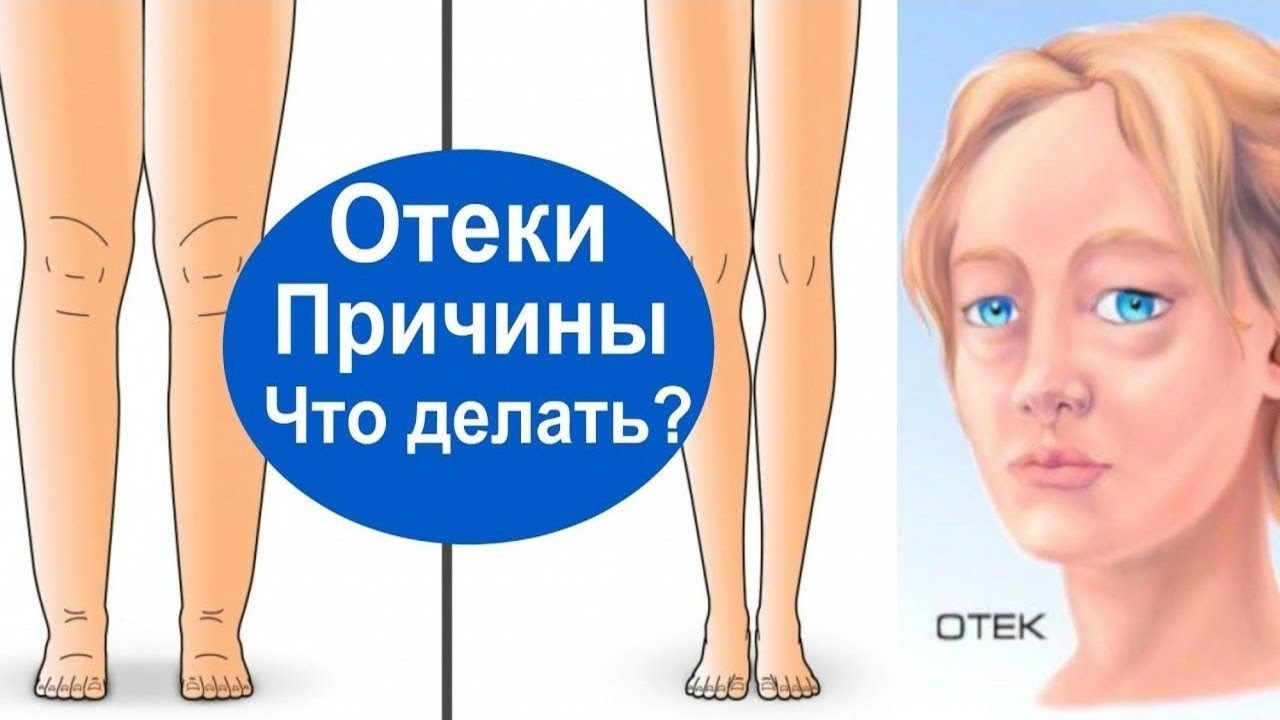 Как лечить отечность