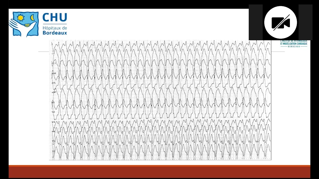 Les indications et les recommandations de programmation d’un DAI Medtronic