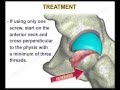 Slipped Capital Femoral Epiphysis - Everything You Need To Know - Dr. Nabil Ebraheim