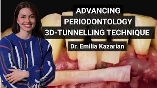 3D TUNNELLING TECHNIQUE | ADVANCING PERIODONTOLOGY w/ Dr. Emilia KAZARIAN