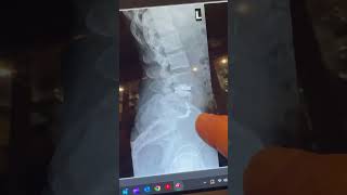 Hybrid Spine Surgery