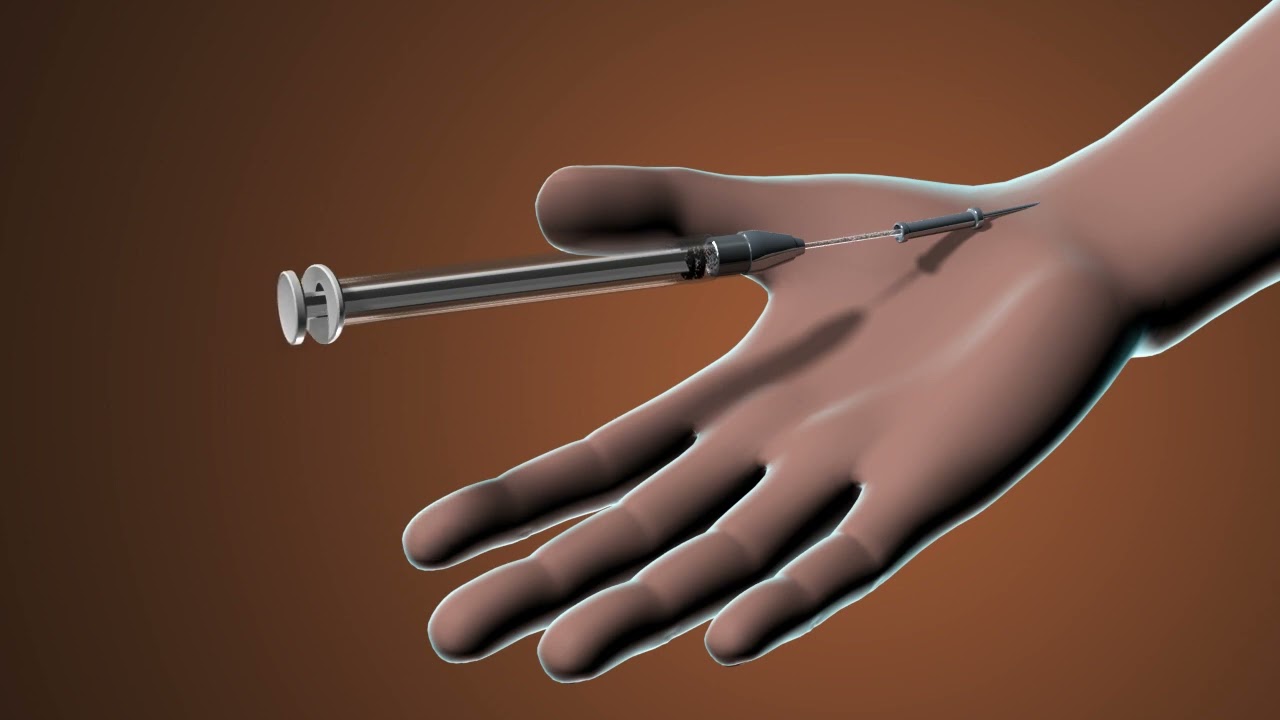 Obesity Institute | Bariatric Artery Embolization | BAE | Appointment (408) 343-8900