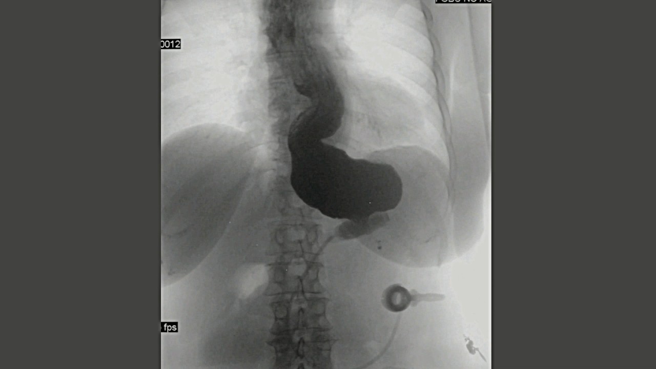 10 years with gastric band Marked dilatation of the esophagus YouTube