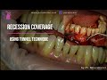 Recession coverage tunnel technique with connective tissue graft