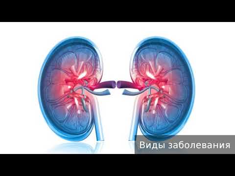 Хронический гломерулонефрит. Как лечить хронический гломерулонефрит.