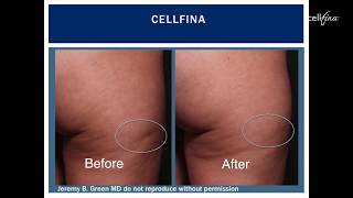 Cellfina Treatment Cellulite