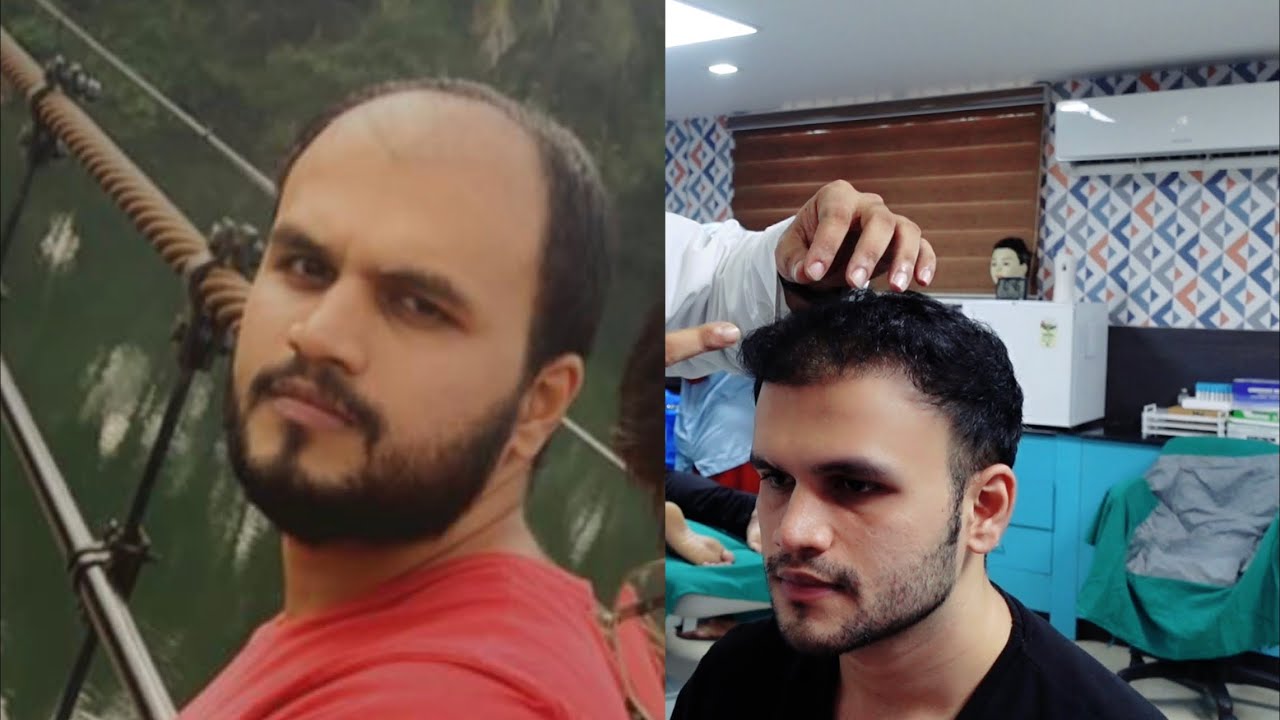 Hair O Dent  FUE Hair Transplant Ernakulam Kochi Kerala  NearMeTrade