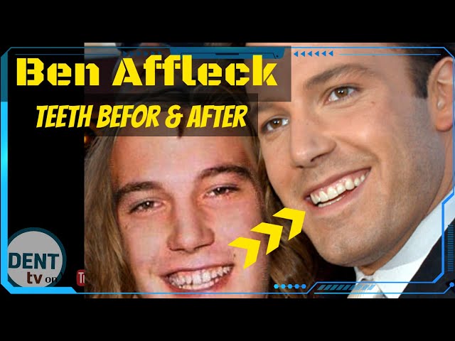 taylor swift before and after veneers