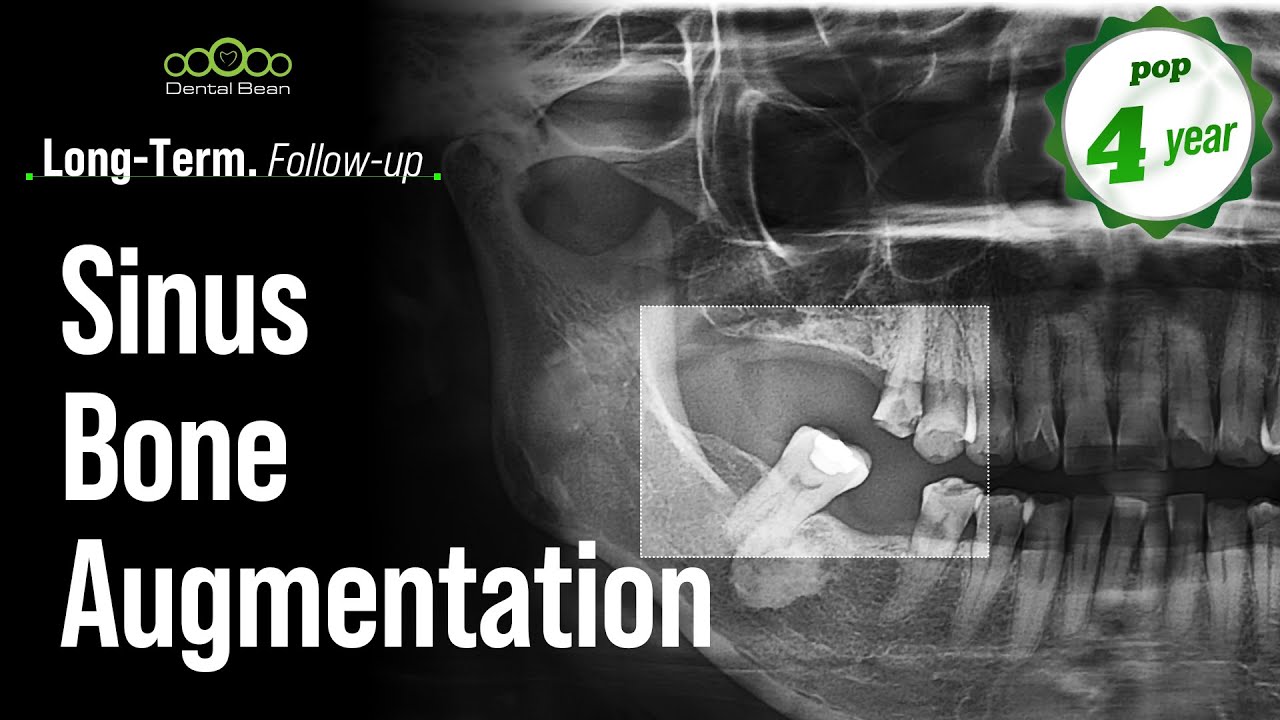 Sinus Bone Augmentation [Dr. Kim Jaeyoon] - YouTube