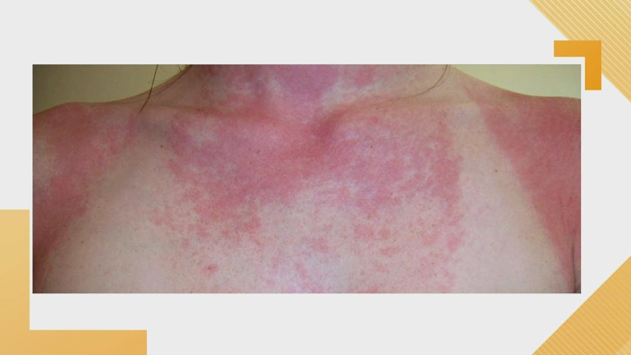 Itchy Rash Caused By Sun Exposure at Maria Harrington blog