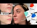TESTING HERO MIGHTY PATCH & MICRO POINT ACNE PATCHES ON MY HORMONAL ACNE FOR 1 WEEK