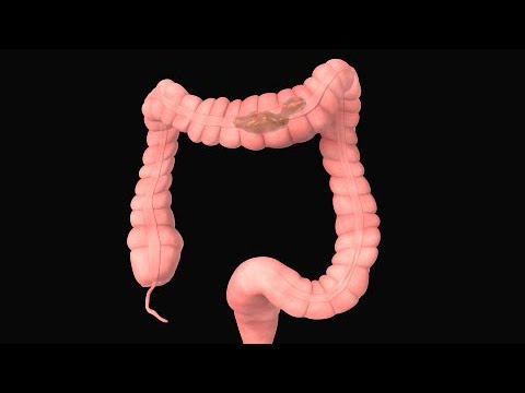 Vídeo: Síndrome De Intestino Irritable Versus Síndrome Carcinoide