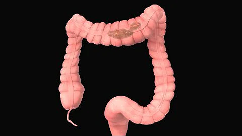 ¿Debería hacerse una colonoscopia si padece síndrome del intestino irritable?