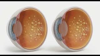 Decoding the Macula  Z Axis Pathology and the Differentials of