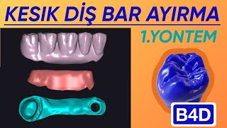 Kesi̇k Di̇ş Bar Ayirma Yöntem