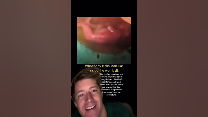 En Caul Birth - ER Doctor Reacts