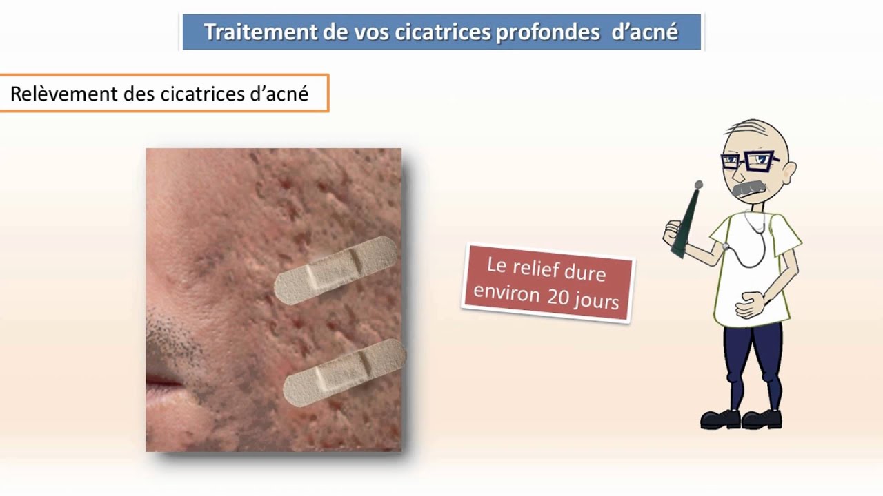 Traitement des cicatrices profondes d’acné