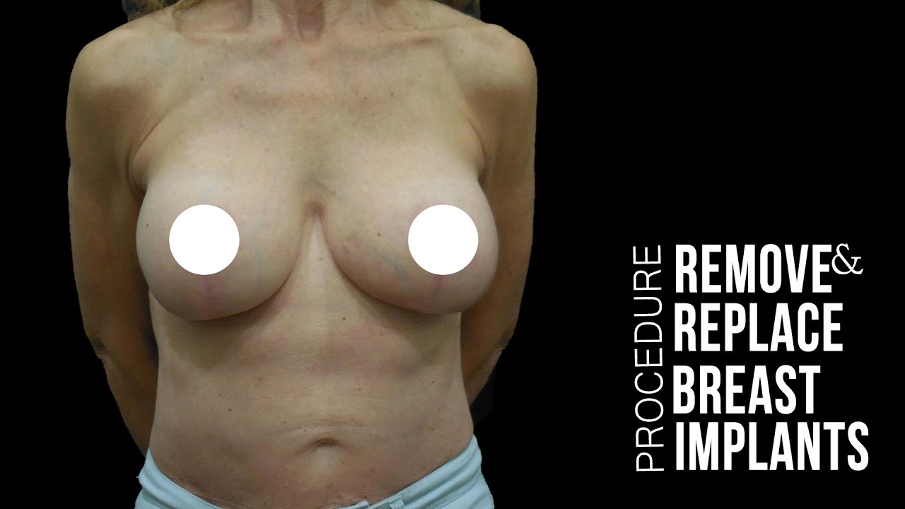 Largest breast implants