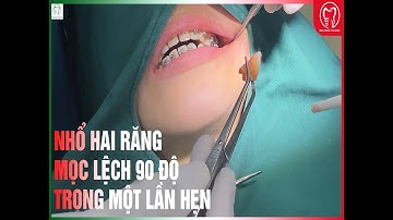 NHỔ CÙNG LÚC HAI RĂNG MỌC LỆCH 90 ĐỘ TẠI ITALIANO THÁI NGUYÊN