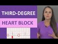 Understanding Third Degree Heart Block