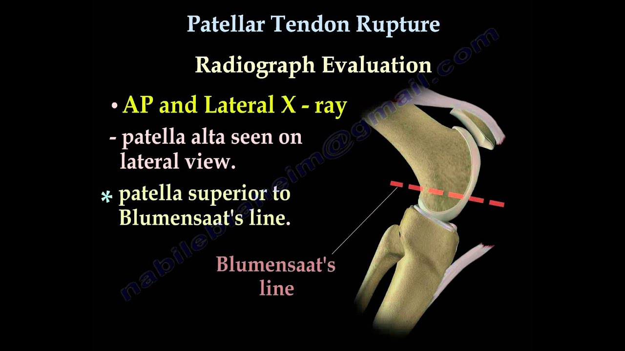 Patellar Tendon Rupture - Everything You Need To Know - Dr. Nabil